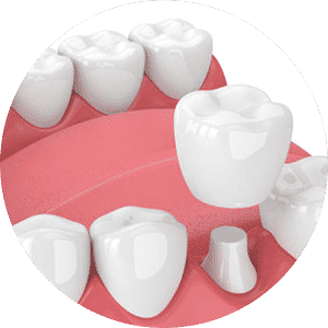 Dental Crowns — Dental in Lake Haven, NSW