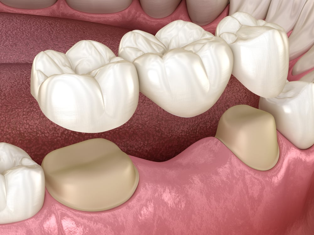 3D Dental Bridge — Dental in Lake Heaven, NSW