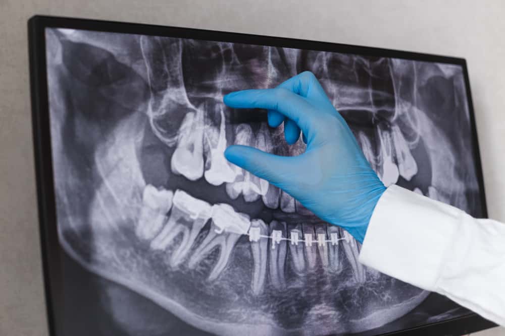 Tooth X-ray — Dental in Lake Heaven, NSW