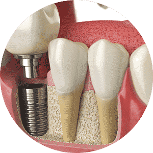 Tooth Implants — Dental in Lake Heaven, NSW